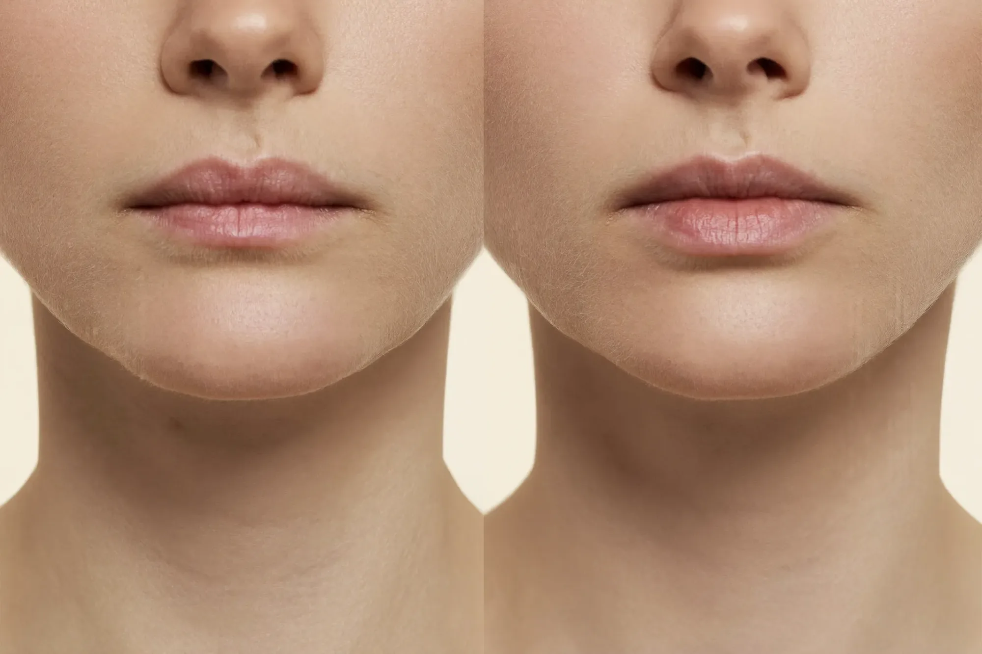 Illustrative before-and-after of subtle balanced lip enhancement with dermal filler