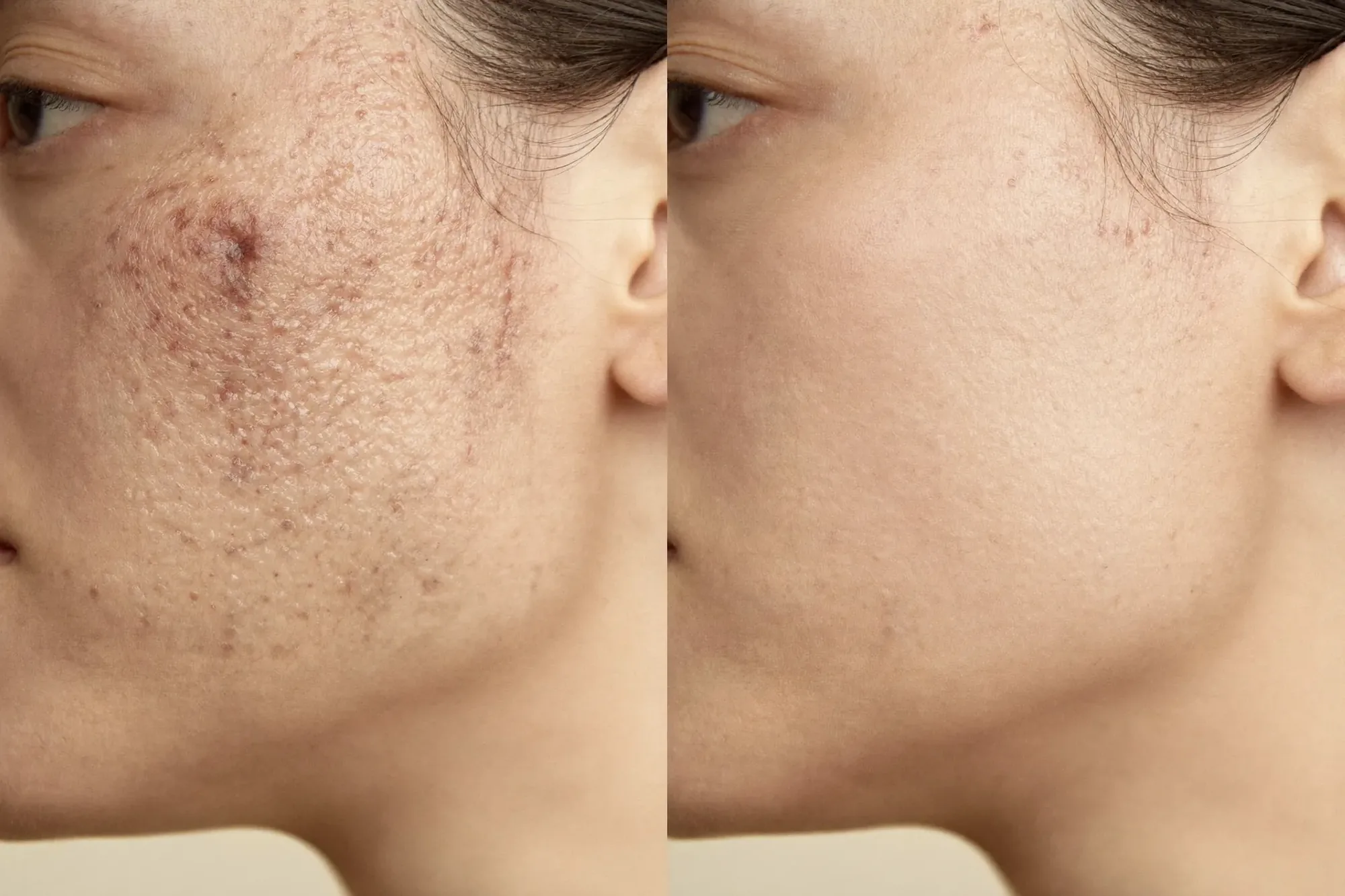Illustrative before-and-after of smoother skin texture and reduced acne scars after microneedling with PRP